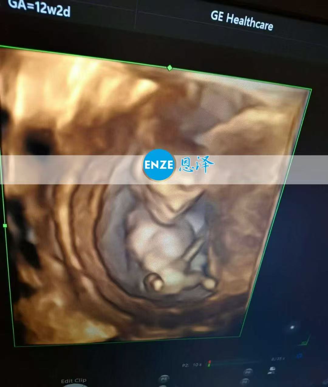 格鲁吉亚试管婴儿助孕爱心使者12周产检顺利，步入稳定期