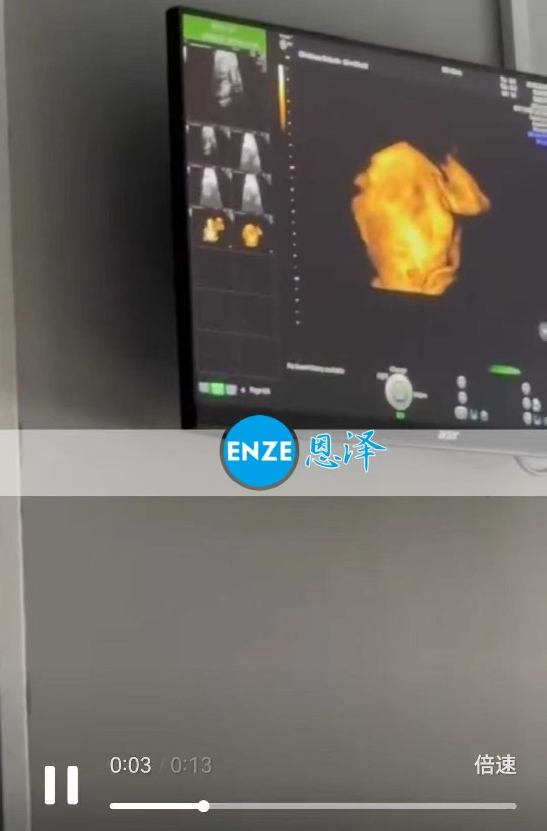 格鲁吉亚试管婴儿助孕爱心使者30周产检顺利通过