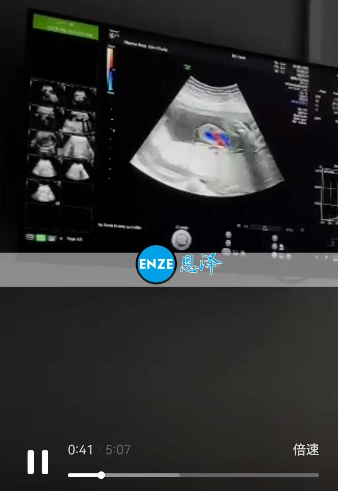 格鲁吉亚试管婴儿助孕爱心使者29周产检顺利通过