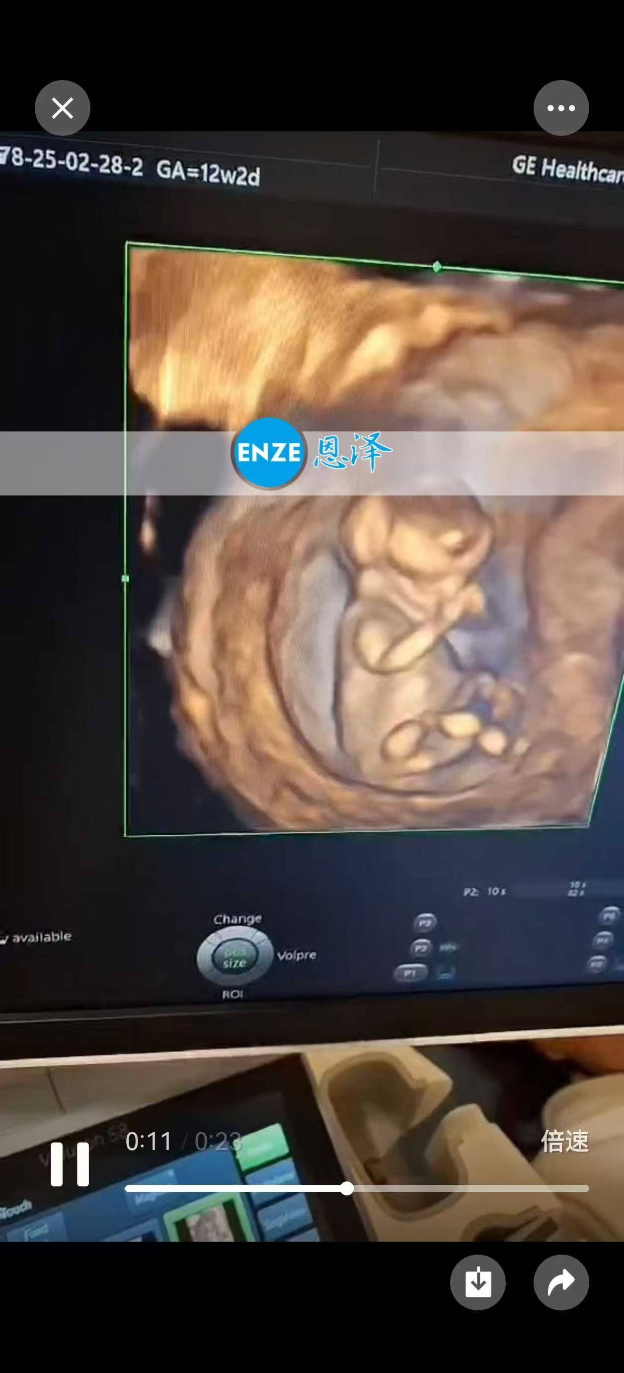 格鲁吉亚试管婴儿助孕爱心使者12周产检顺利，步入稳定期