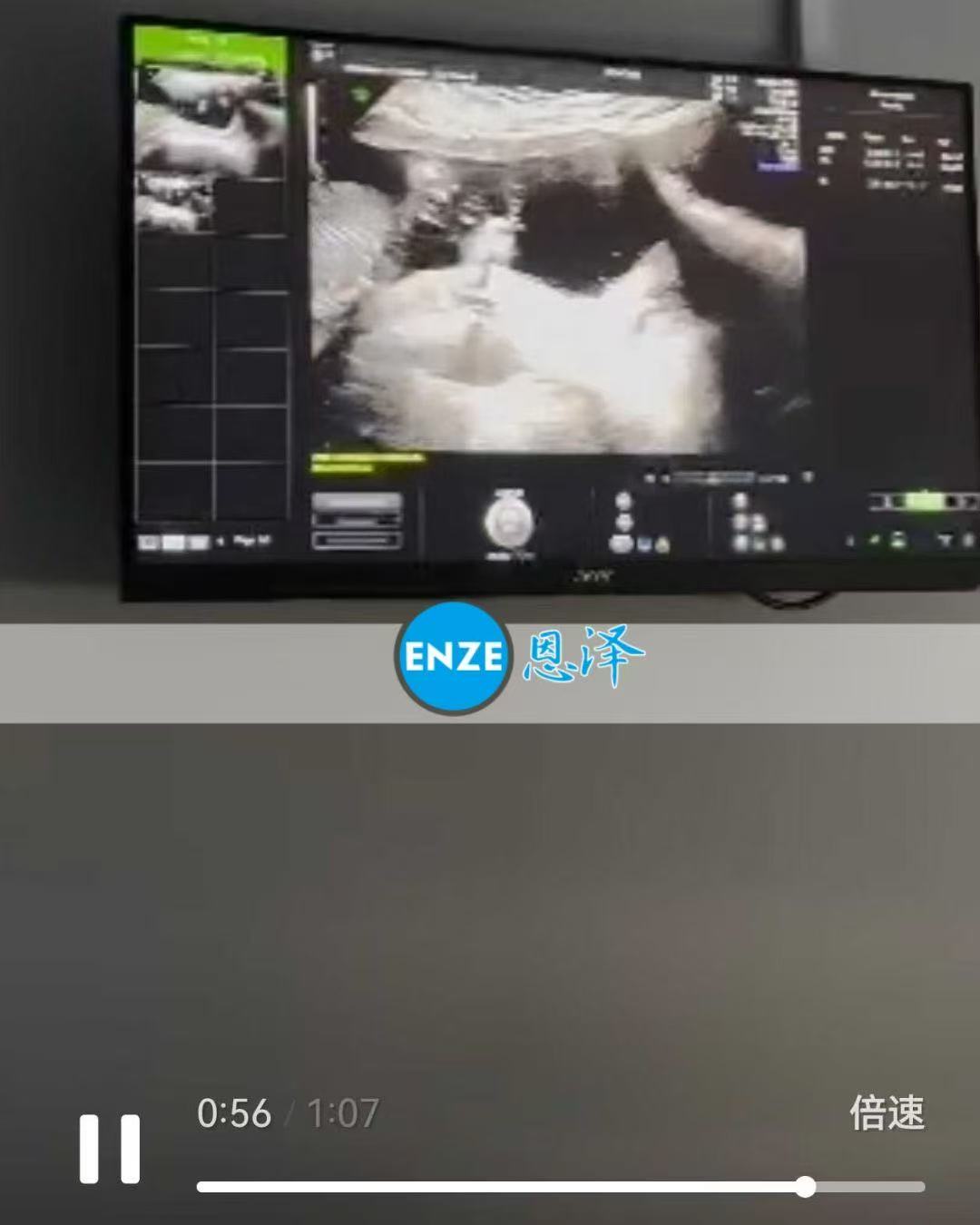 格鲁吉亚试管婴儿助孕爱心使者17周产检顺利过关