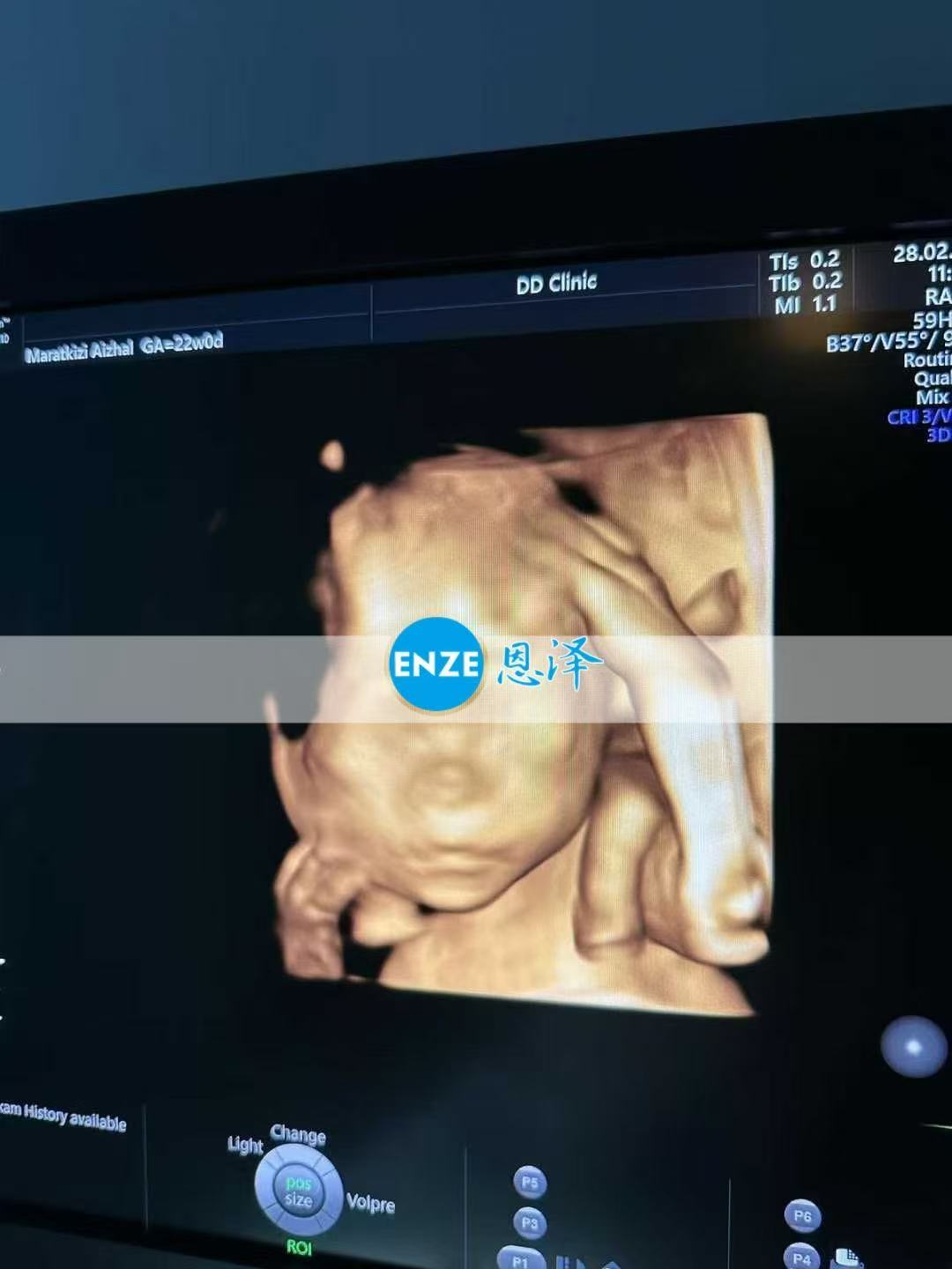 格鲁吉亚试管婴儿助孕爱心使者22周产检顺利通过
