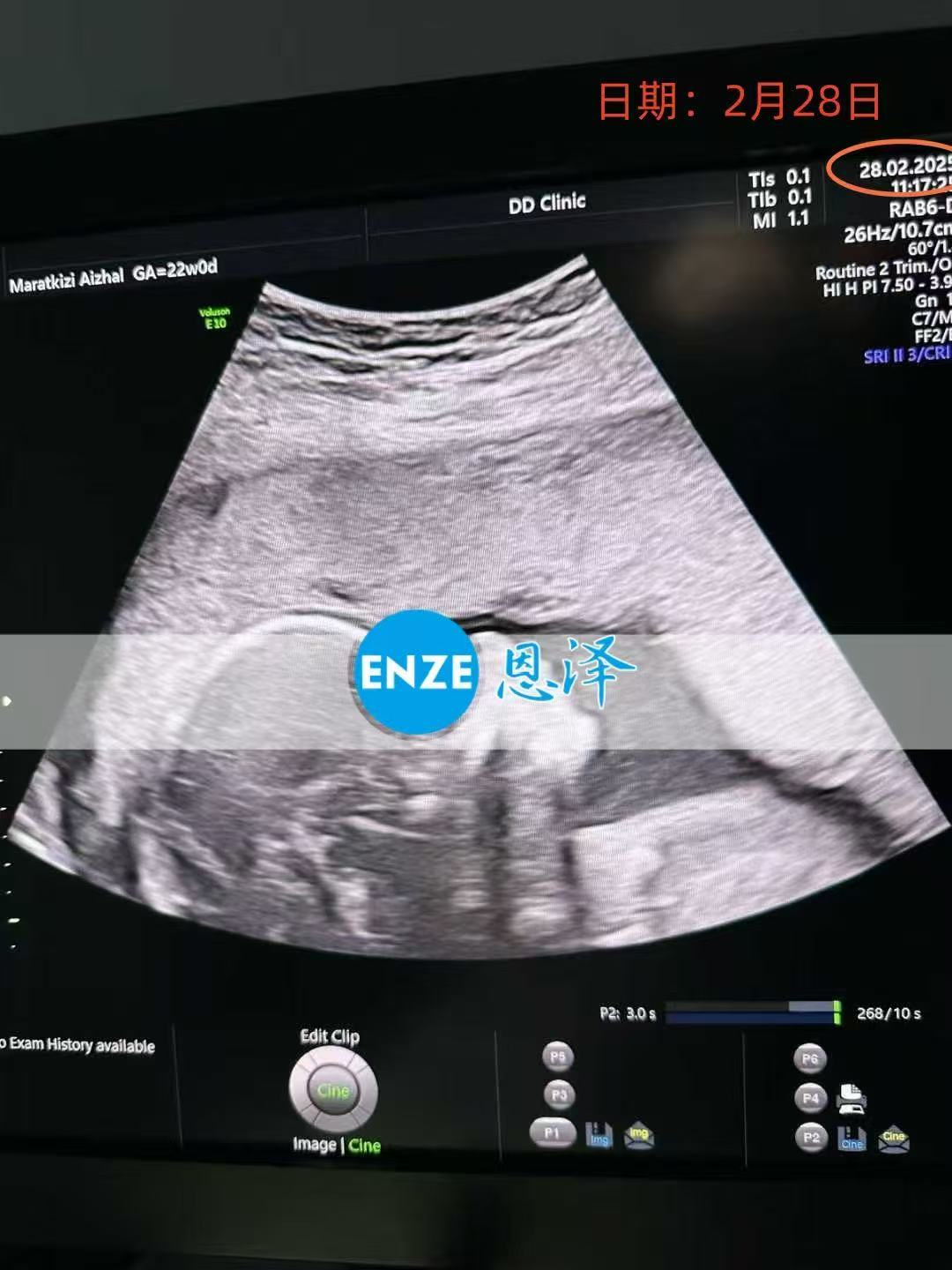 格鲁吉亚试管婴儿助孕爱心使者22周产检顺利通过