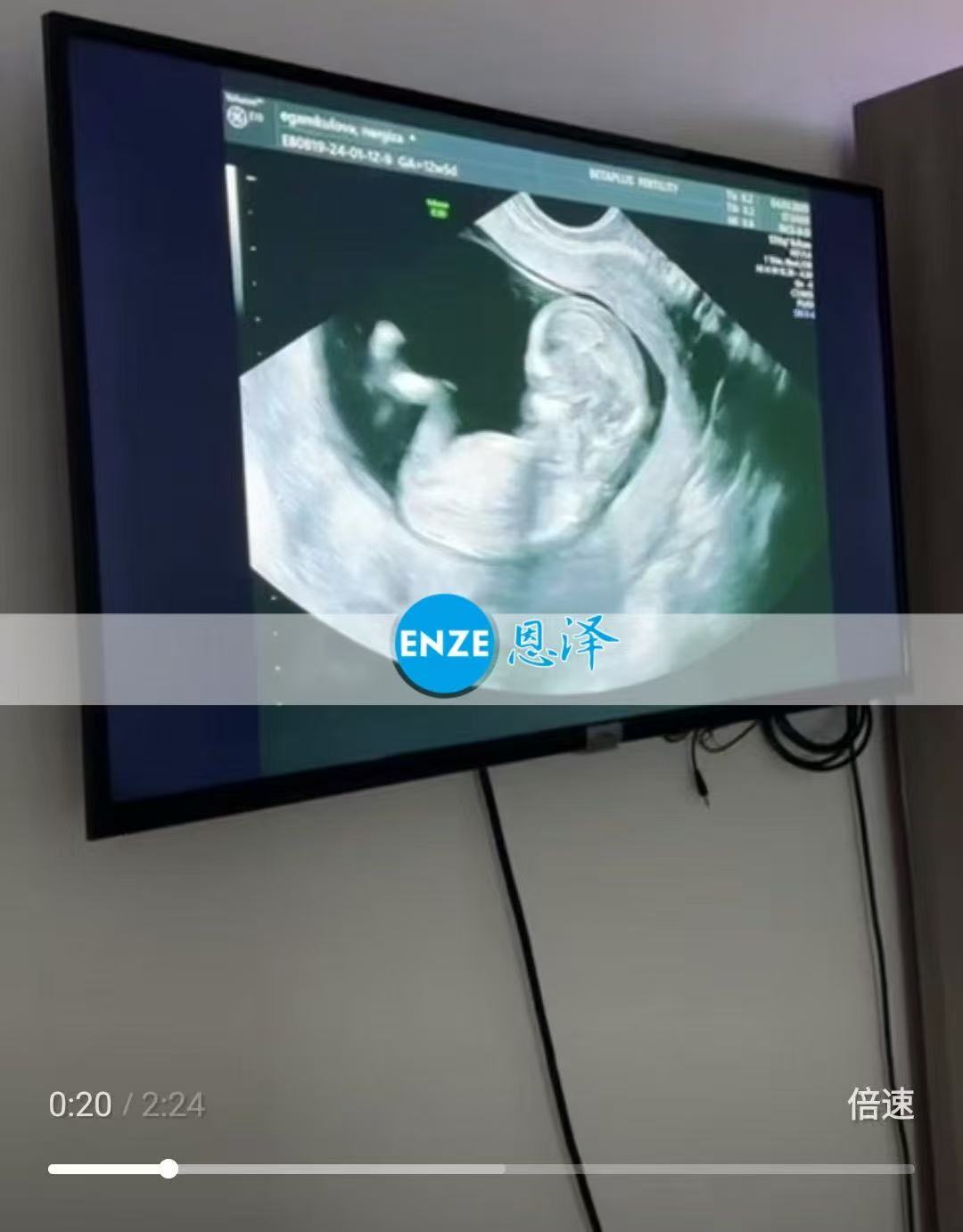 格鲁吉亚试管婴儿助孕爱心使者通过12周产检，正式进入稳定期
