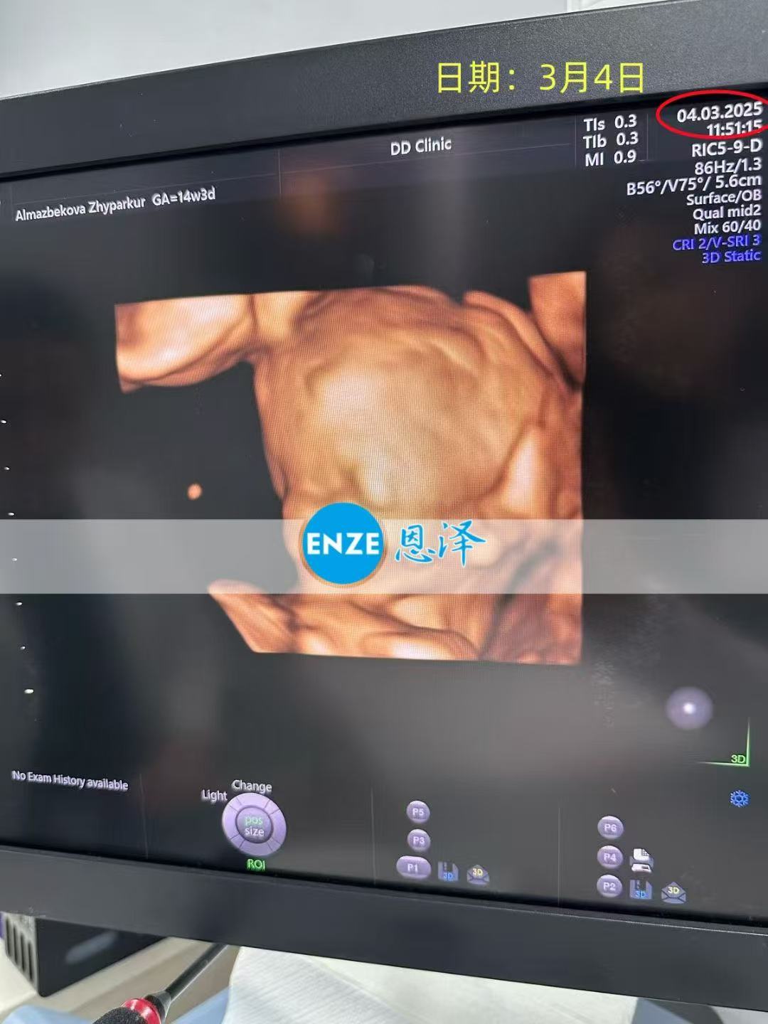 格鲁吉亚试管婴儿助孕爱心使者14周产检顺利通过