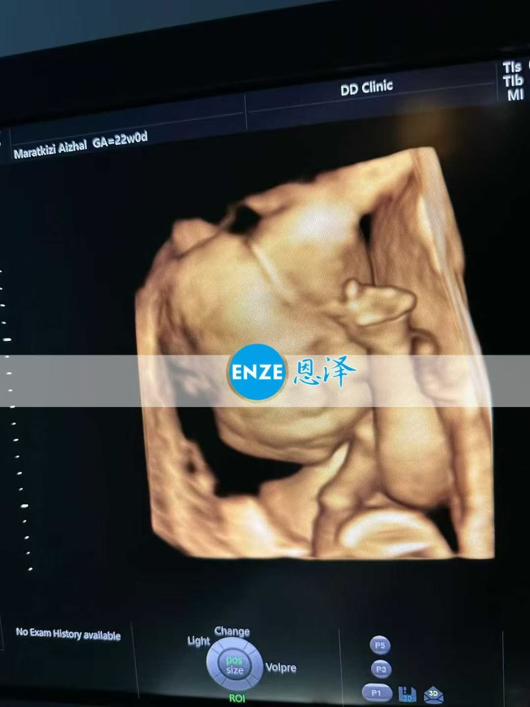 格鲁吉亚试管婴儿助孕爱心使者22周产检顺利通过
