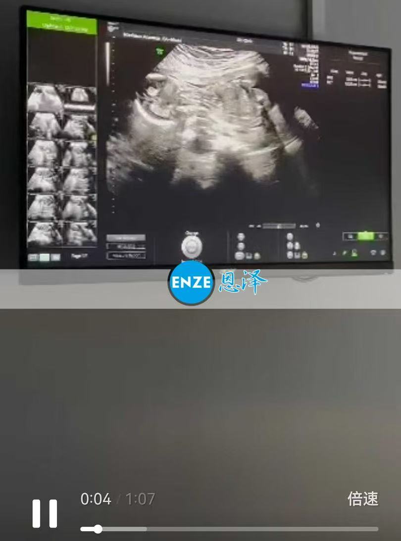 格鲁吉亚试管婴儿助孕爱心使者17周产检顺利过关