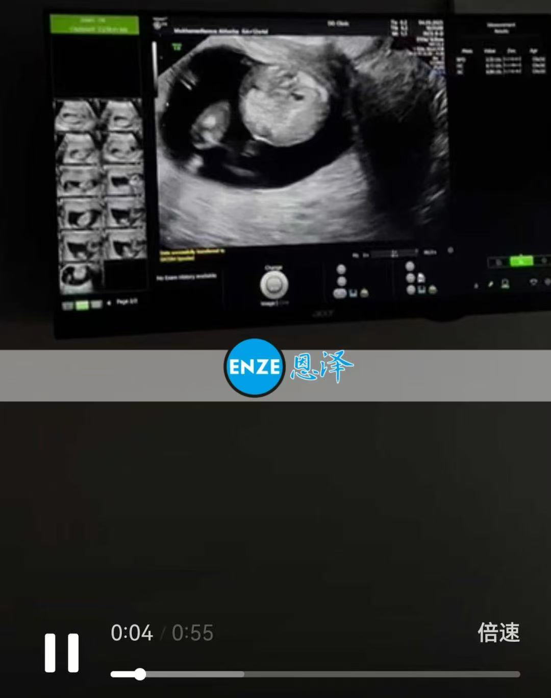 格鲁吉亚试管婴儿助孕爱心使者12周产检顺利，正式进入稳定期