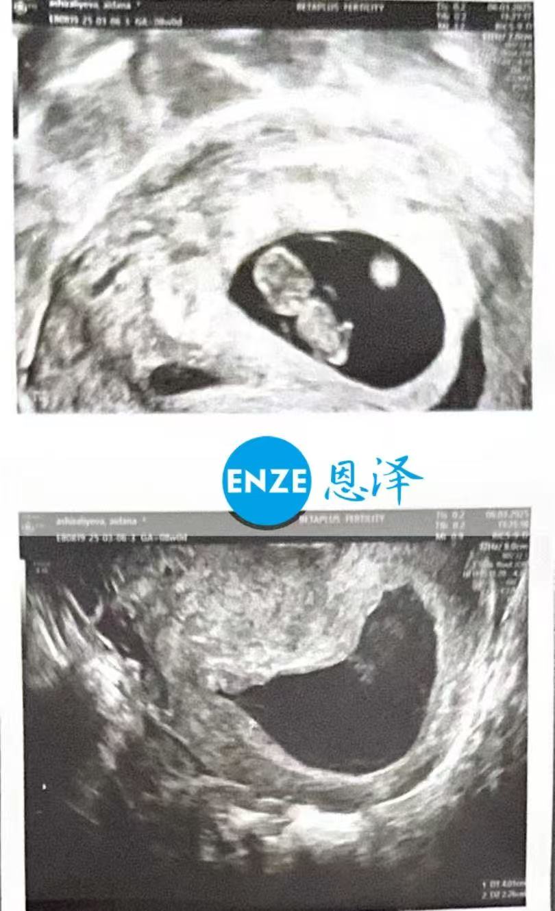 格鲁吉亚试管婴儿助孕爱心使者8周产检进展顺利