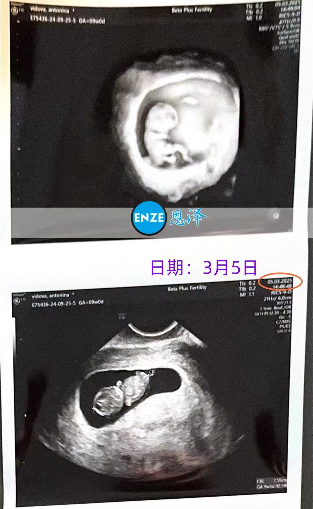 格鲁吉亚试管婴儿助孕爱心使者9周产检顺利通过