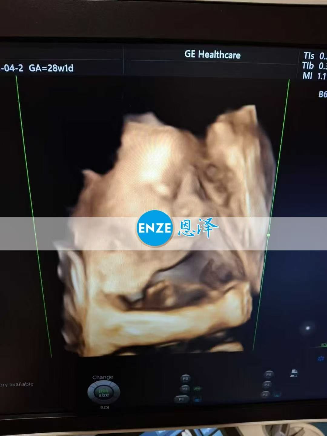 乌克兰试管婴儿助孕爱心使者28周产检进展顺利