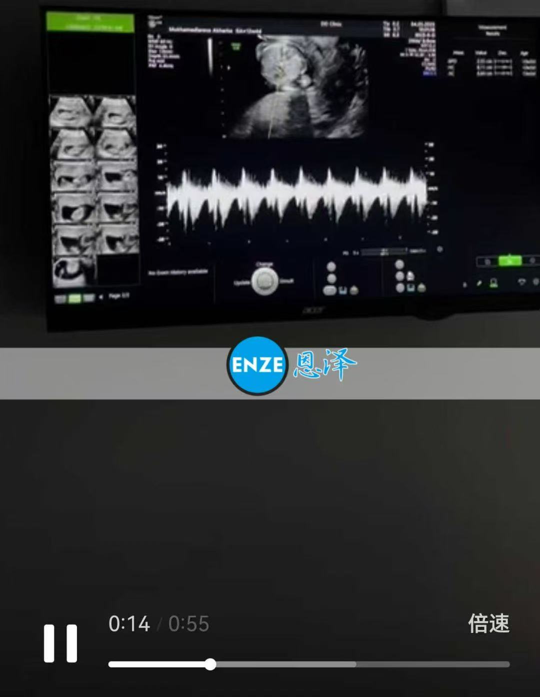 格鲁吉亚试管婴儿助孕爱心使者12周产检顺利，正式进入稳定期