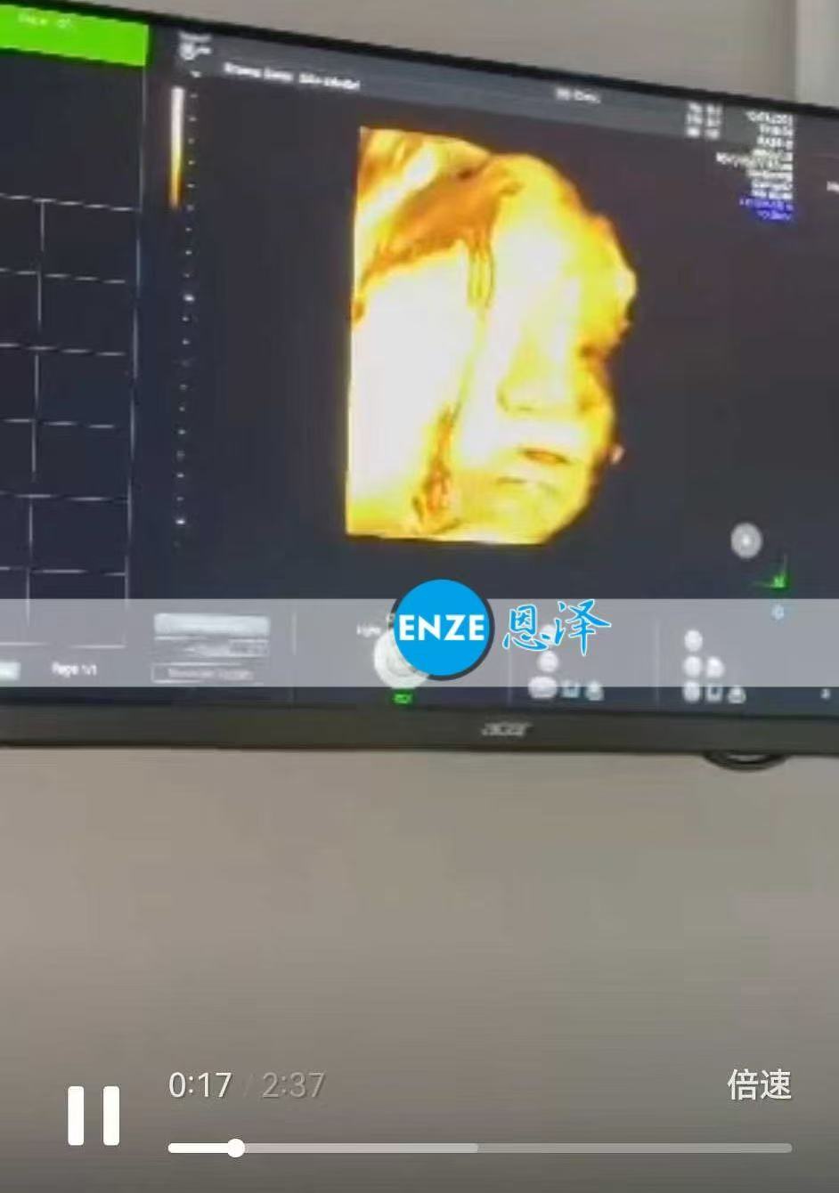 格鲁吉亚试管婴儿助孕爱心使者33周产检进展顺利