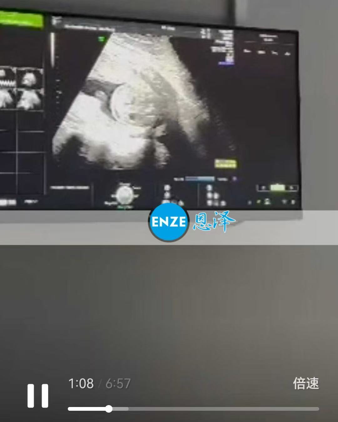 格鲁吉亚试管婴儿助孕爱心使者19周产检顺利通过