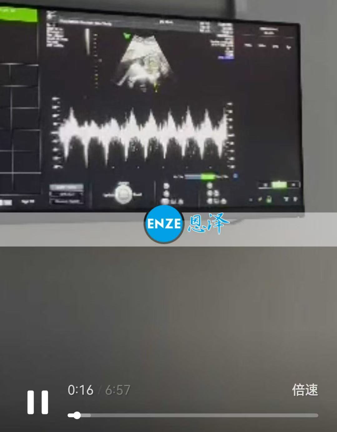 格鲁吉亚试管婴儿助孕爱心使者19周产检顺利通过