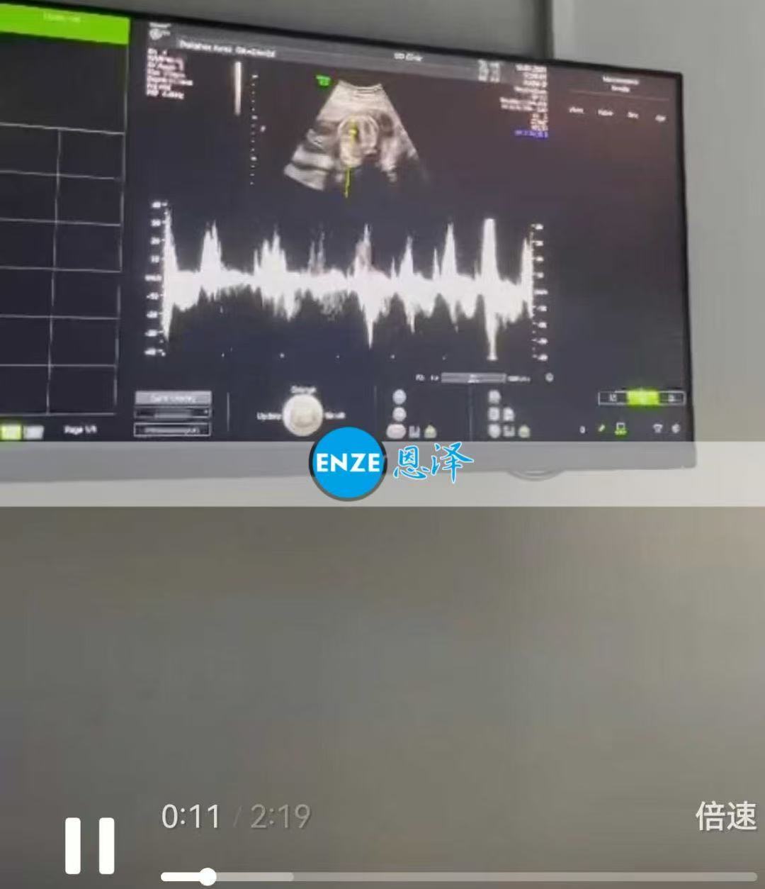 格鲁吉亚试管婴儿助孕爱心使者24周产检进展顺利