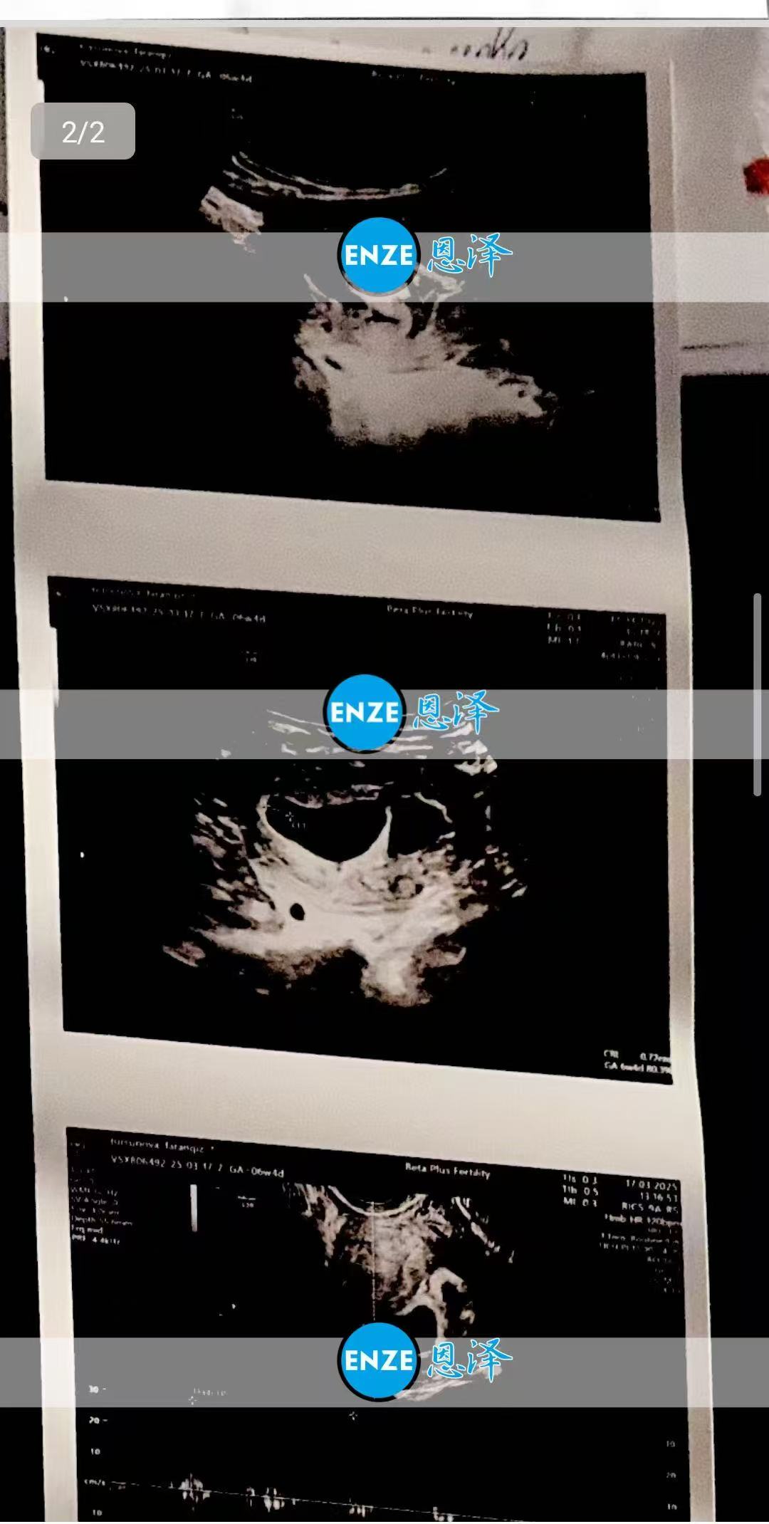 格鲁吉亚试管婴儿助孕爱心使者首次产检确认怀上双胎