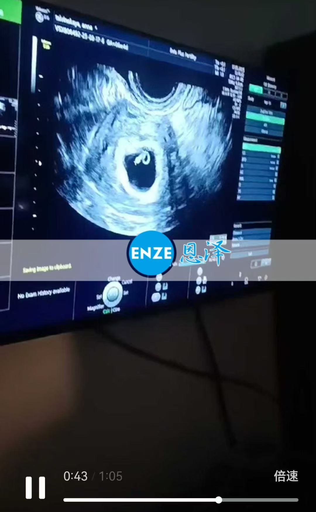 格鲁吉亚试管婴儿助孕爱心使者6周产检进展顺利