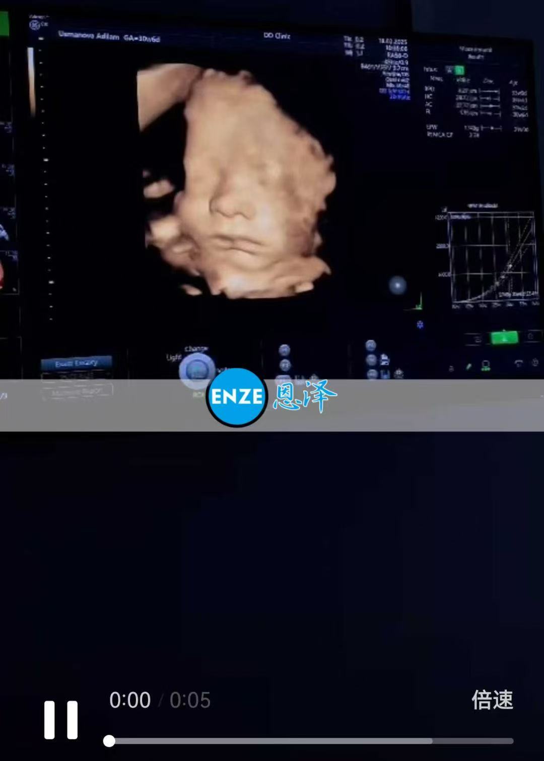 格鲁吉亚试管婴儿助孕爱心使者30周产检顺利通过