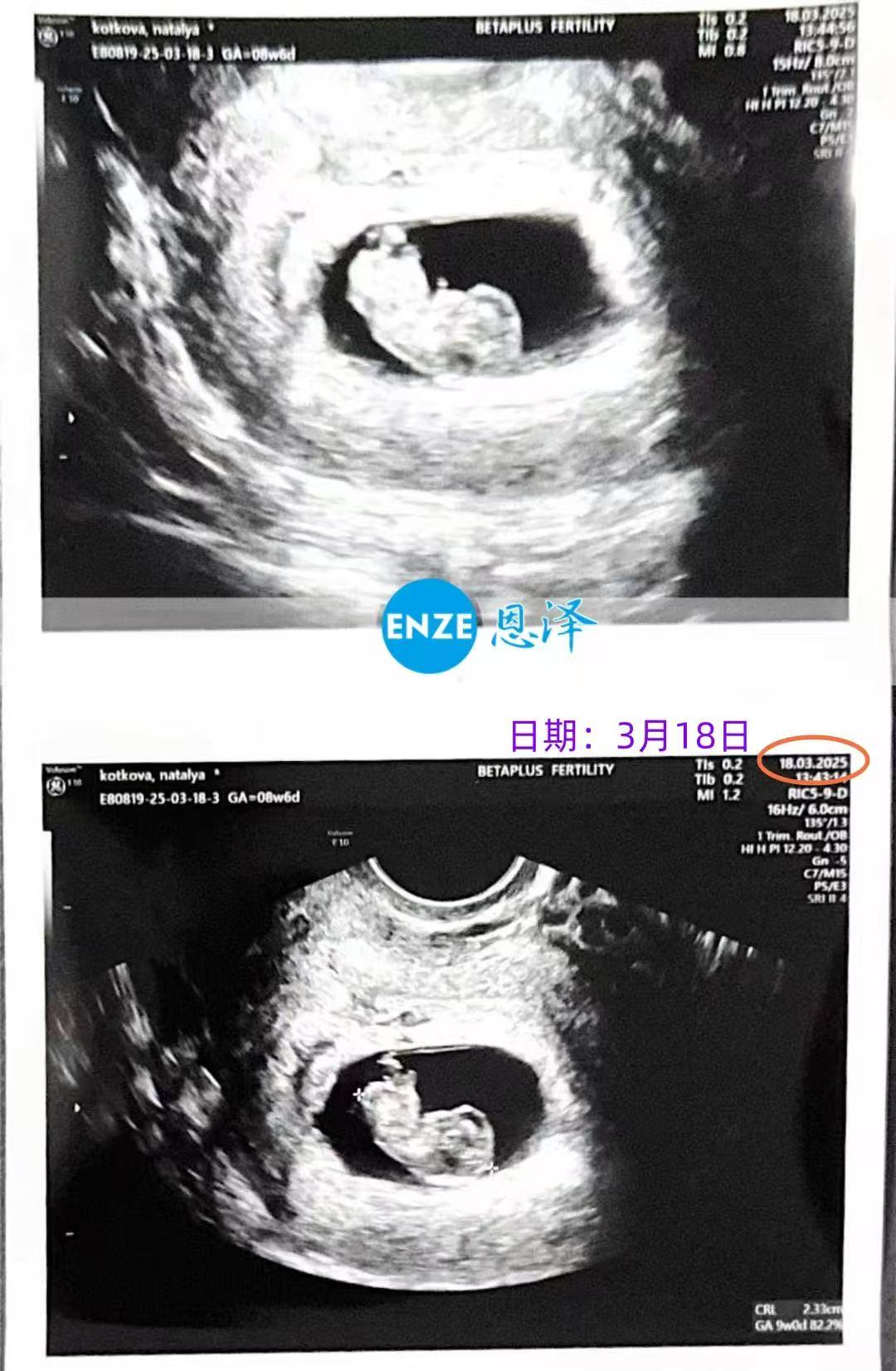 格鲁吉亚试管婴儿助孕爱心使者9周产检进展顺利