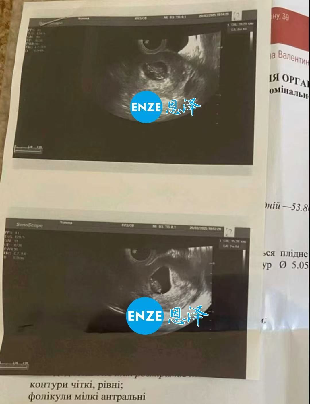 乌克兰试管婴儿助孕爱心使者成功通过8周产检