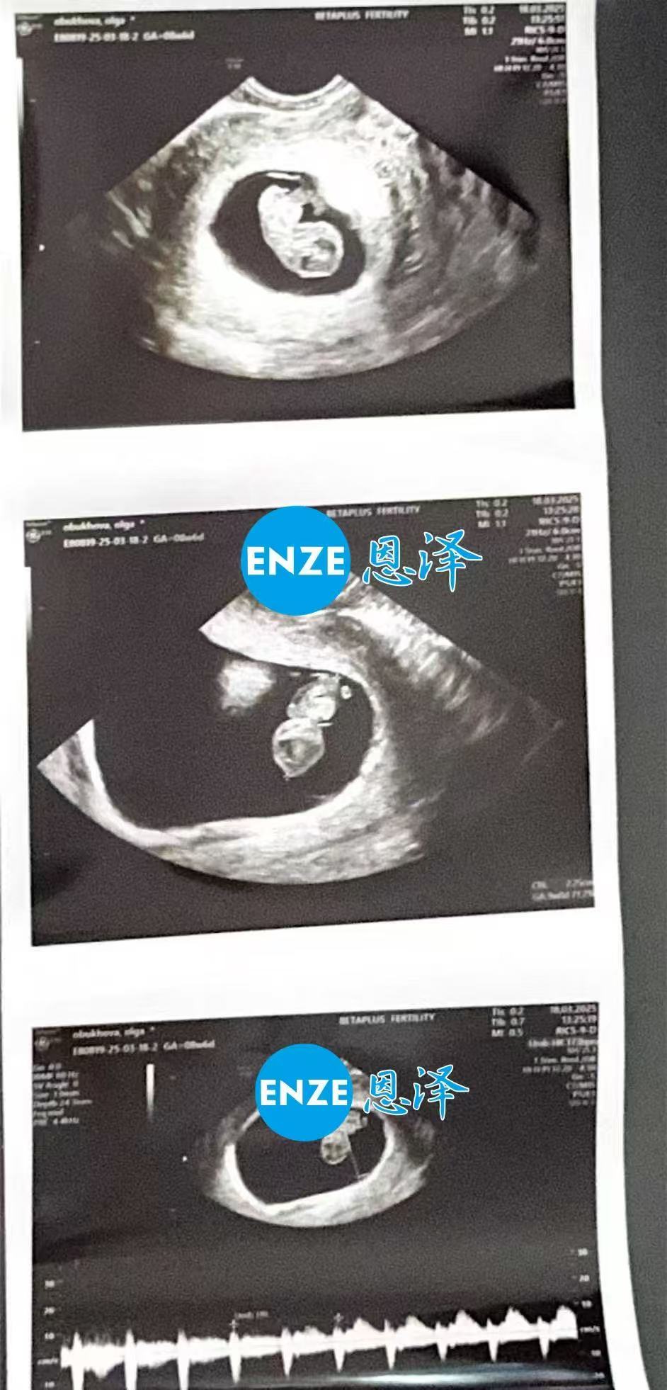 格鲁吉亚试管婴儿助孕爱心使者9周产检顺利通过