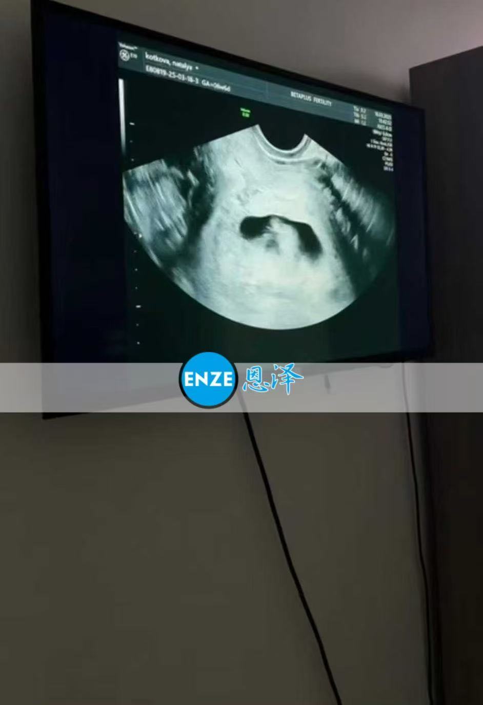 格鲁吉亚试管婴儿助孕爱心使者9周产检进展顺利