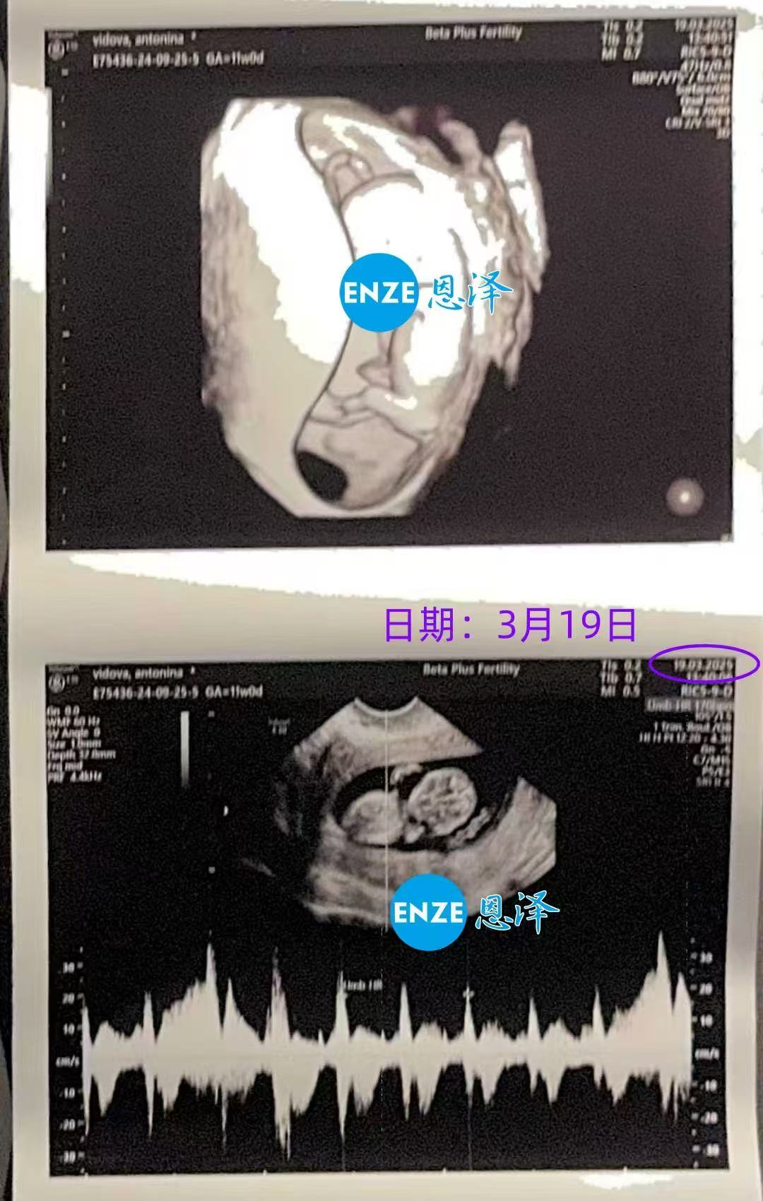 格鲁吉亚试管婴儿助孕爱心使者顺利度过风险期