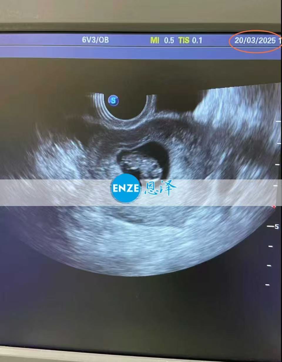 乌克兰试管婴儿助孕爱心使者成功通过8周产检