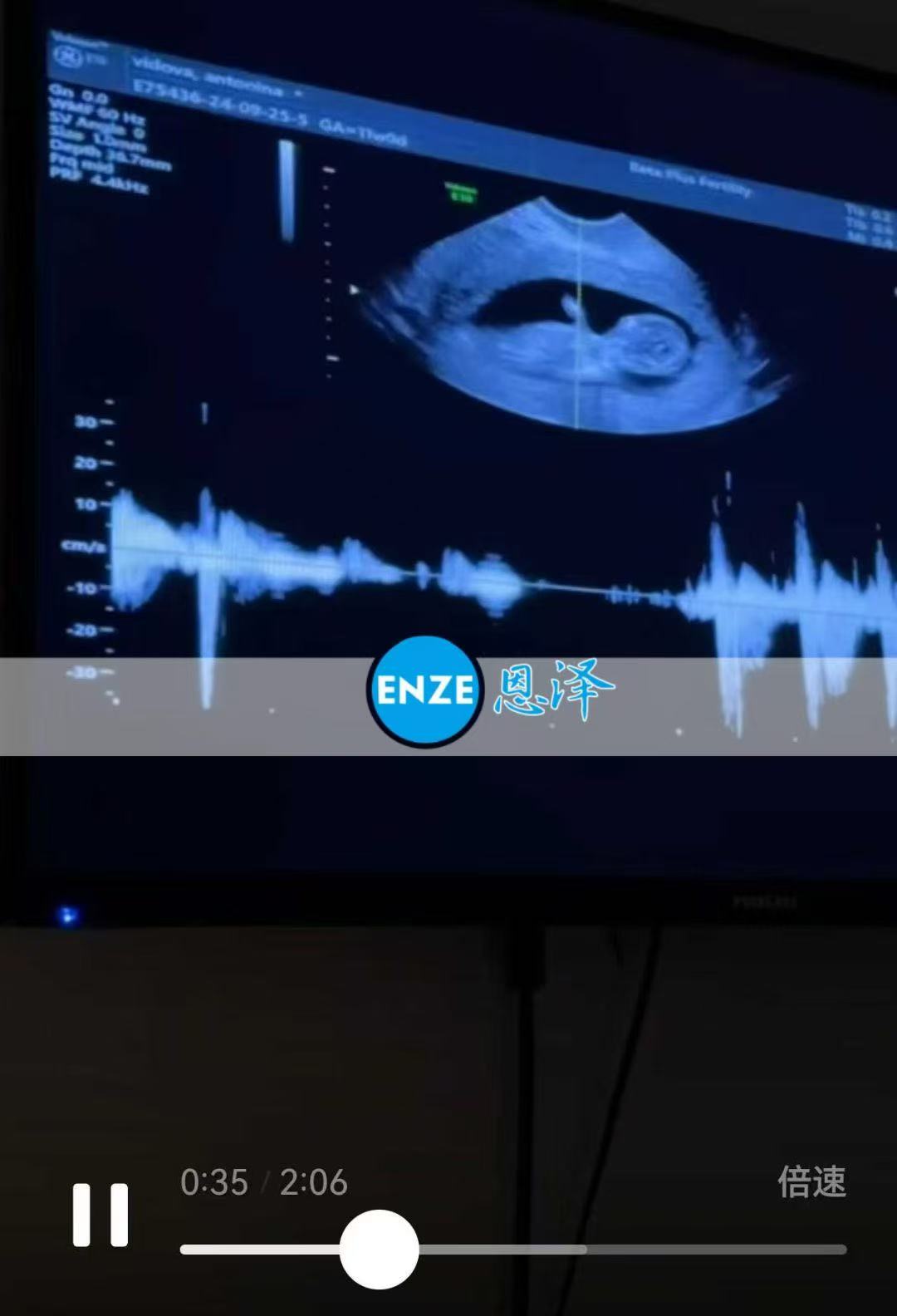格鲁吉亚试管婴儿助孕爱心使者顺利度过风险期