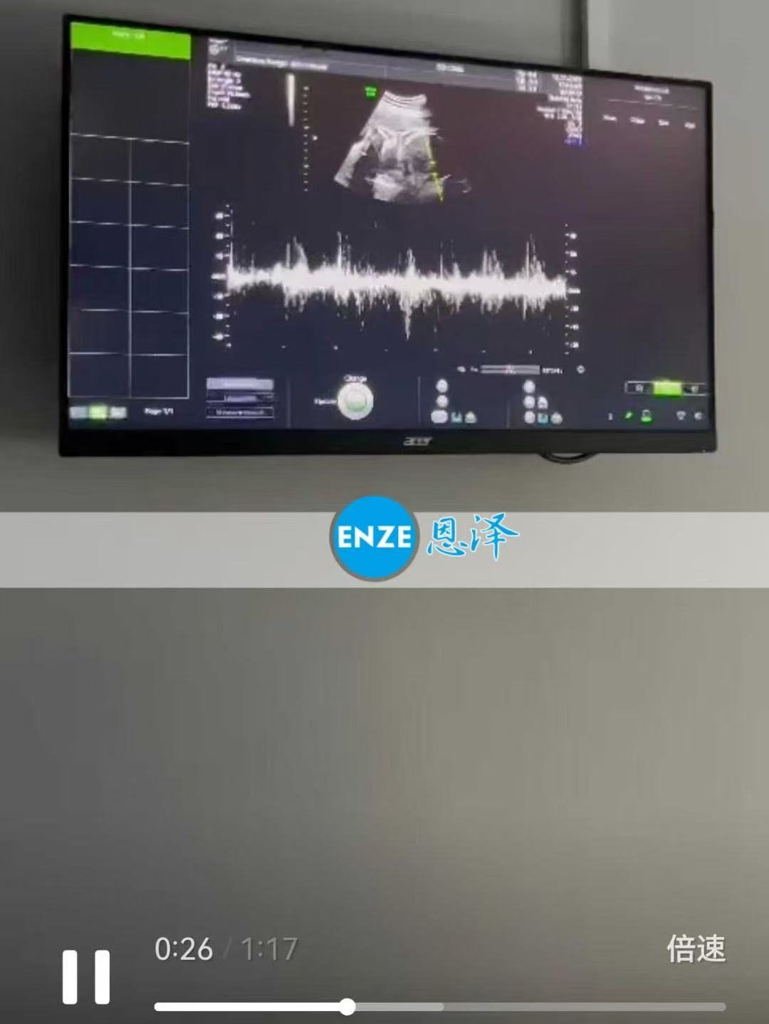 格鲁吉亚试管婴儿助孕爱心使者顺利通过34周产检