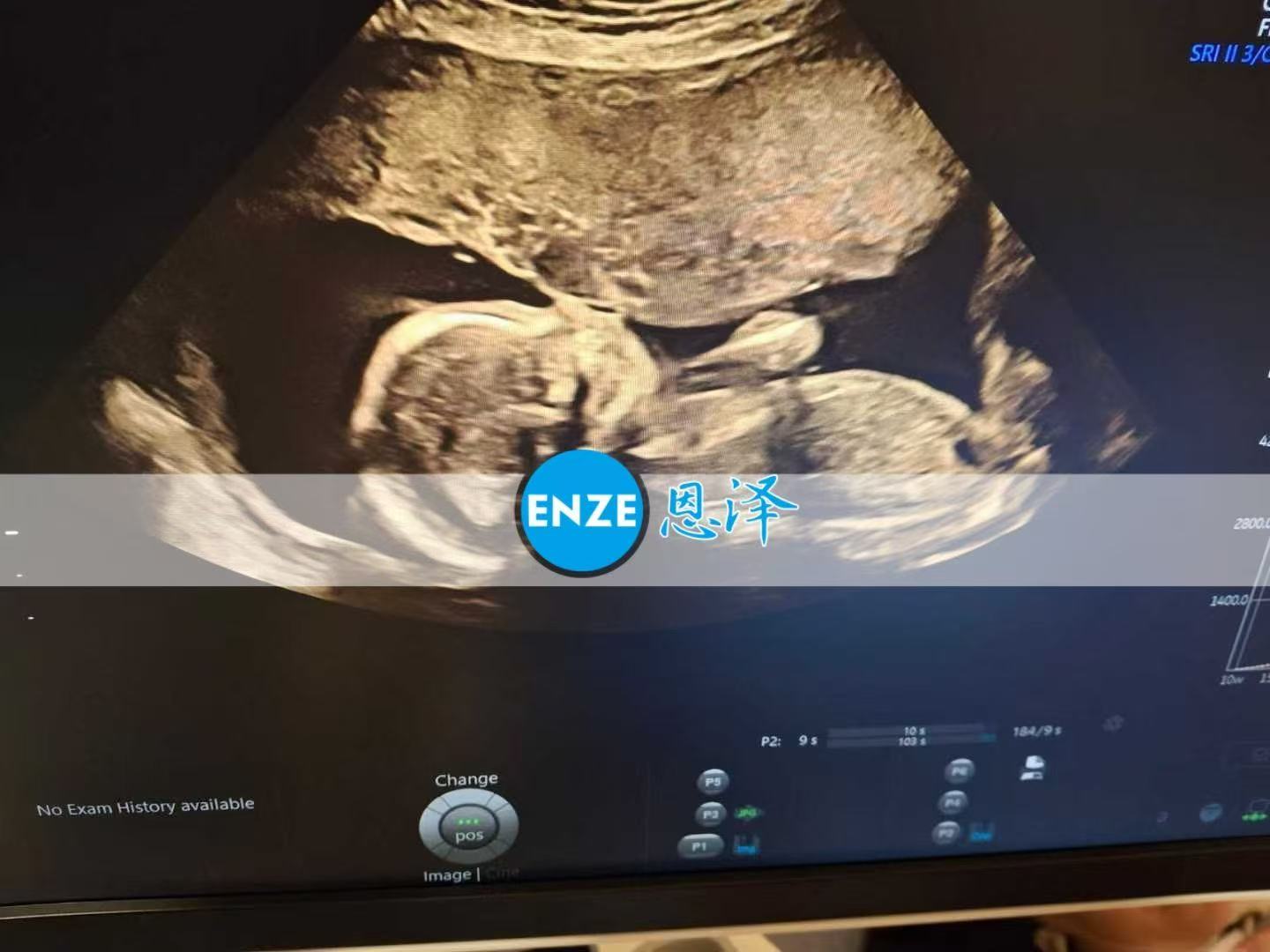 乌克兰试管婴儿助孕爱心使者19周产检顺利过关
