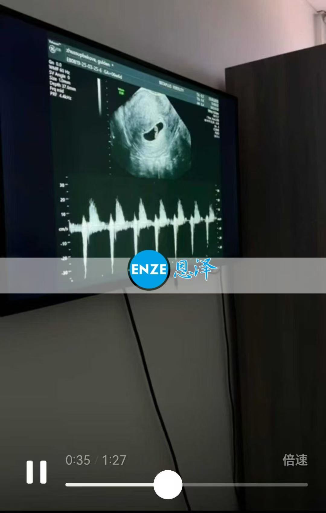格鲁吉亚试管婴儿助孕爱心使者成功通过6周产检