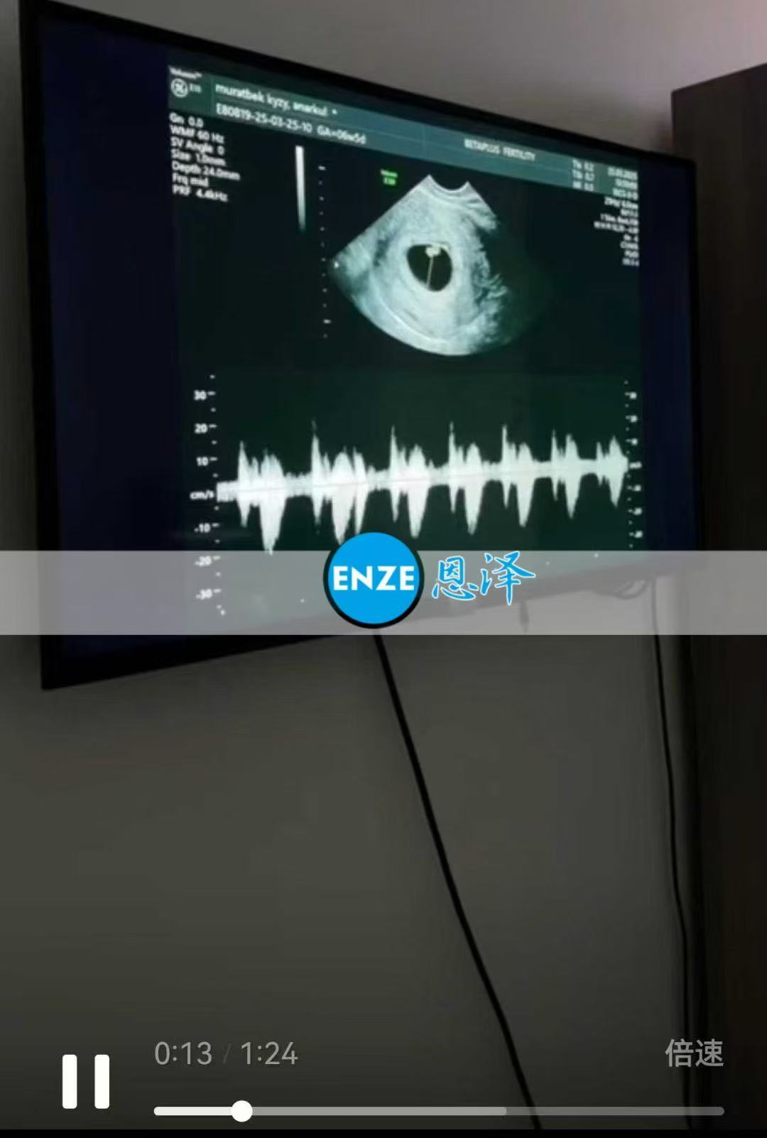 格鲁吉亚试管婴儿助孕爱心使者6周产检顺利通过