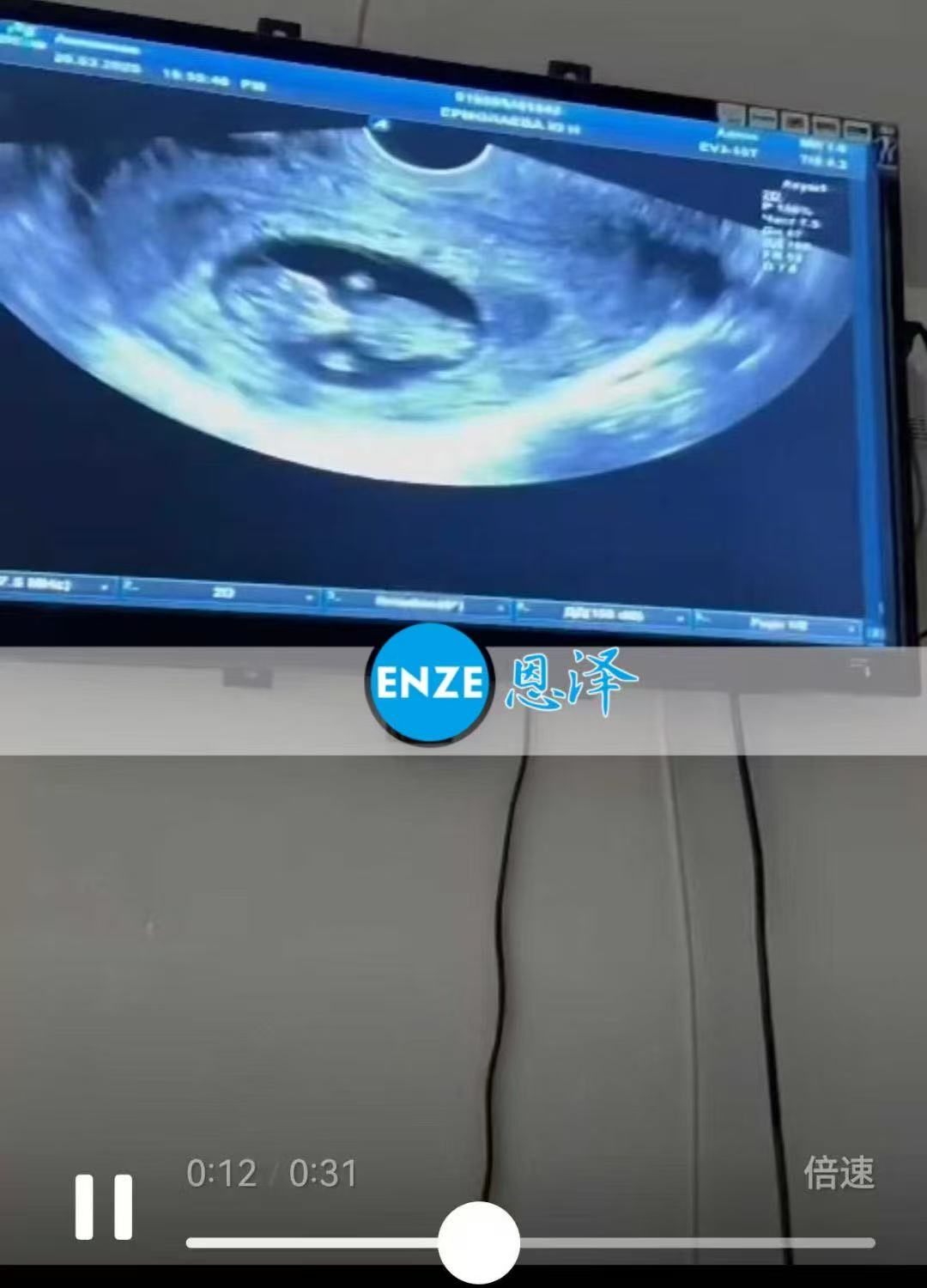 格鲁吉亚试管婴儿助孕爱心使者顺利通过11周产检