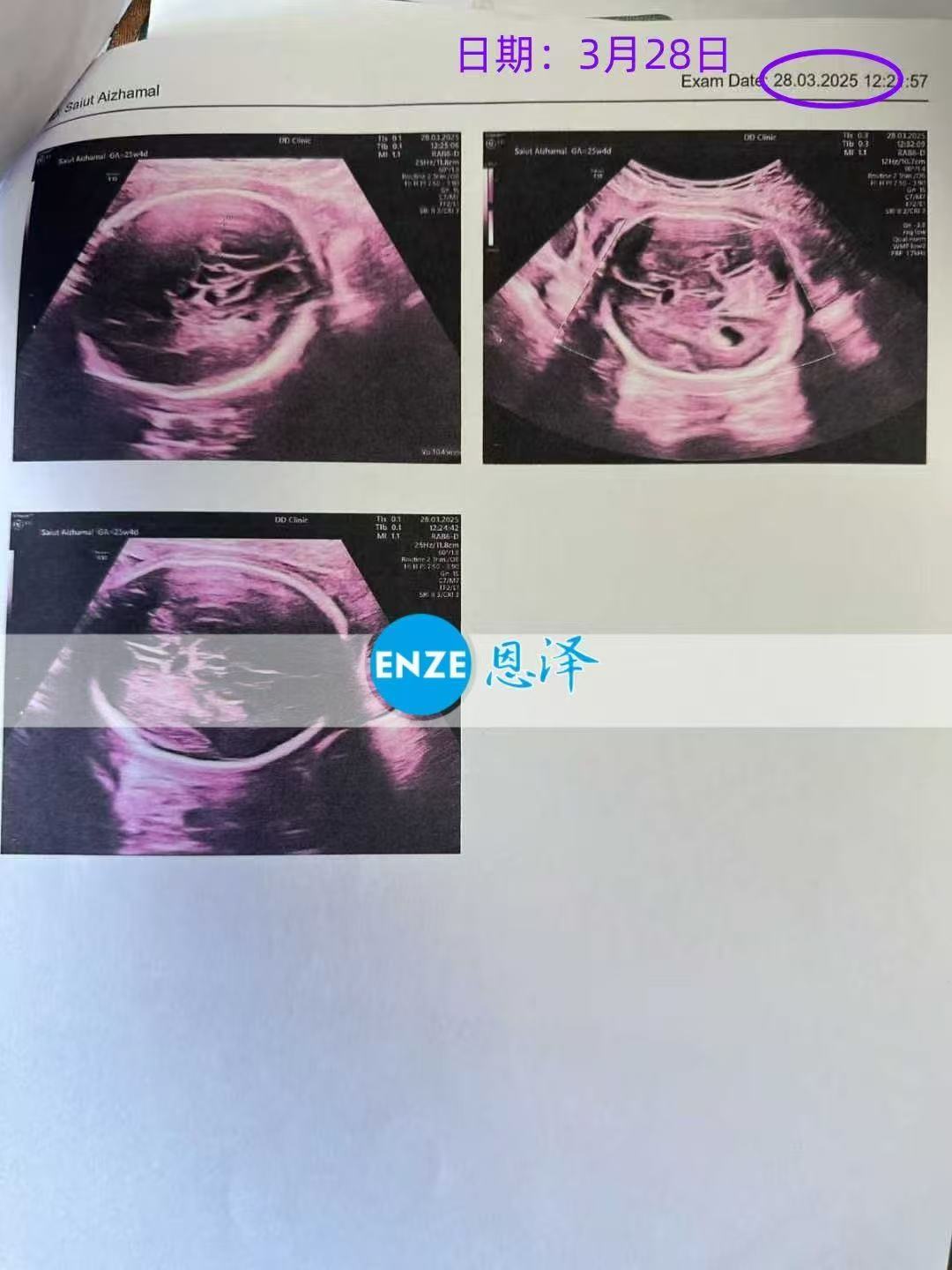 格鲁吉亚试管婴儿助孕爱心使者成功通过25周产检