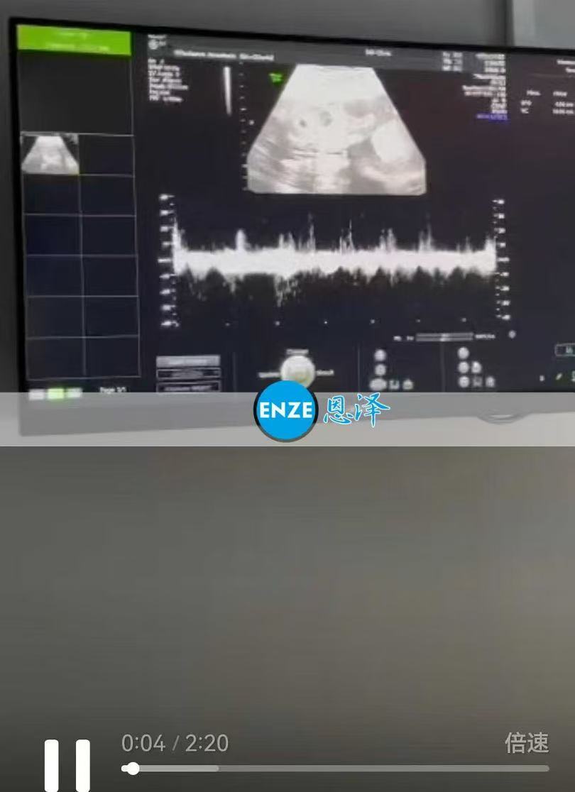 格鲁吉亚试管婴儿助孕爱心使者21周产检顺利通过