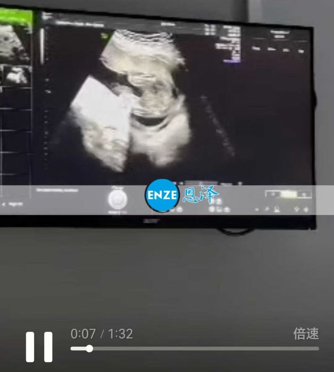 格鲁吉亚试管婴儿助孕爱心使者21周产检顺利过关