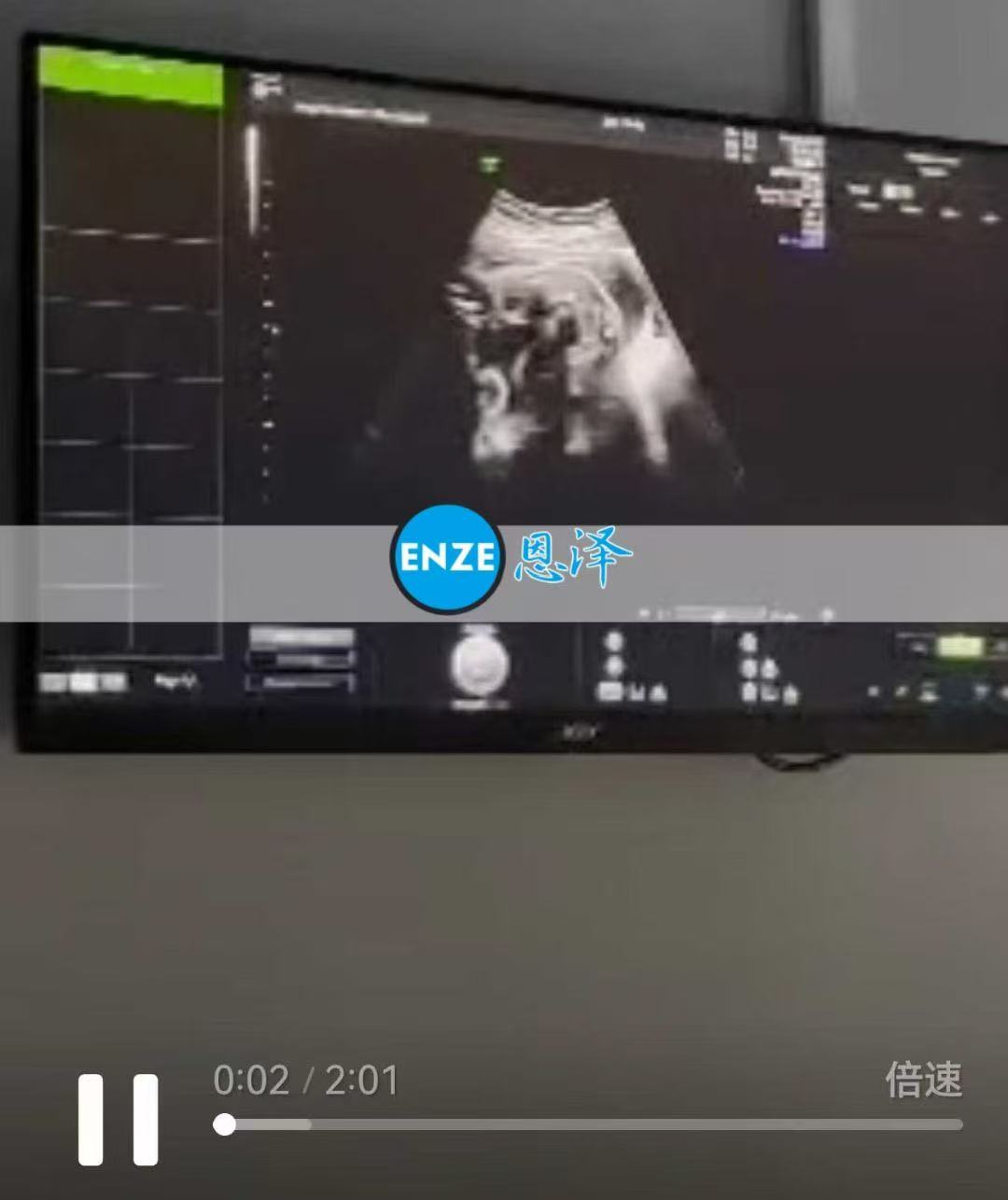 格鲁吉亚试管婴儿助孕爱心使者26周产检顺利通过