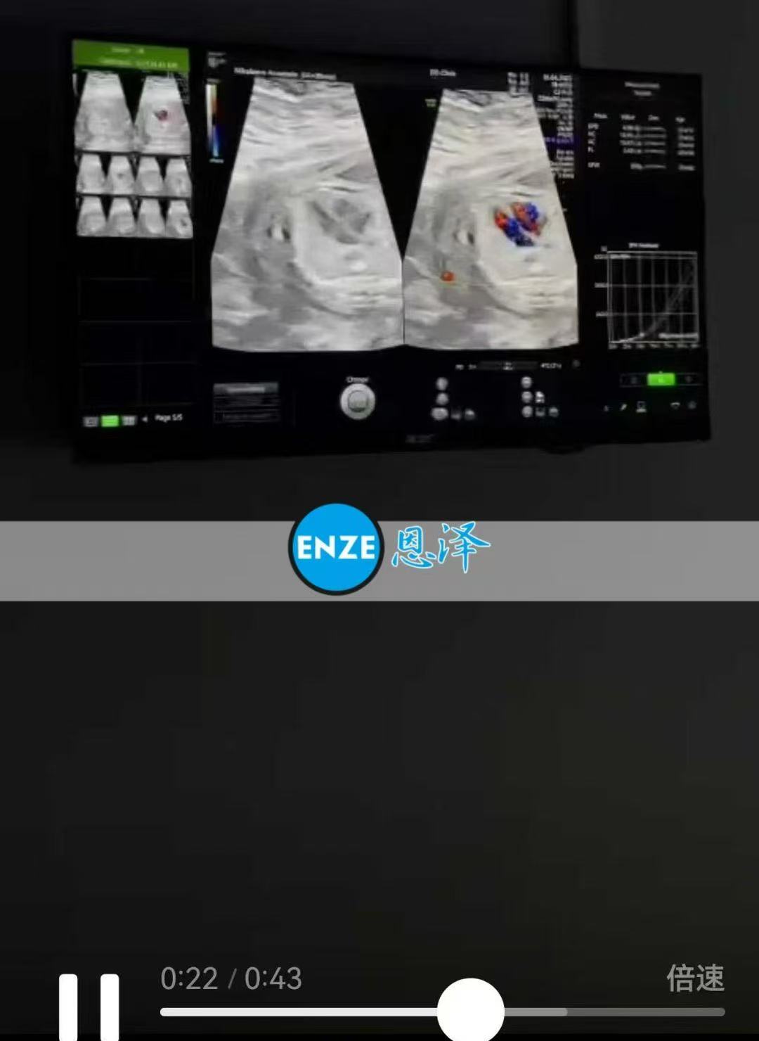 格鲁吉亚试管婴儿助孕爱心使者21周产检顺利通过