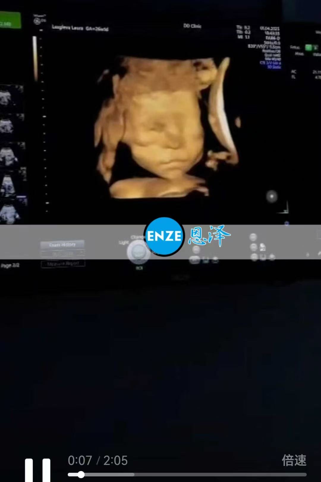 格鲁吉亚试管婴儿助孕爱心使者26周产检顺利通过