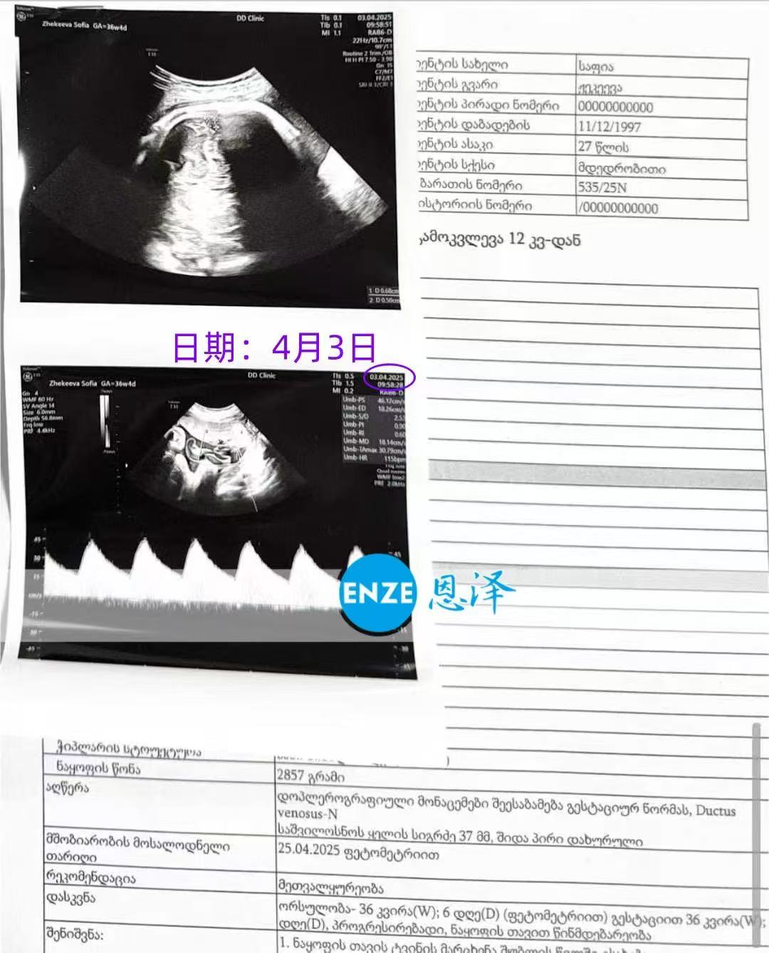 格鲁吉亚试管婴儿助孕爱心使者36周产检顺利通过
