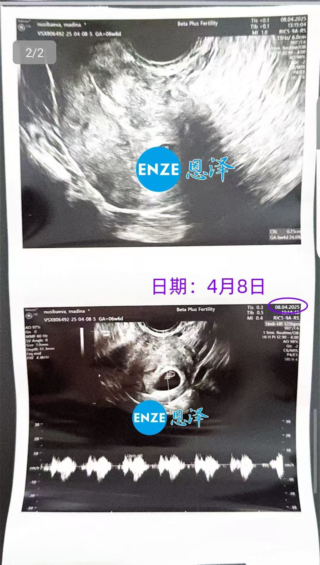 格鲁吉亚试管婴儿助孕爱心使者第一次产检顺利通过