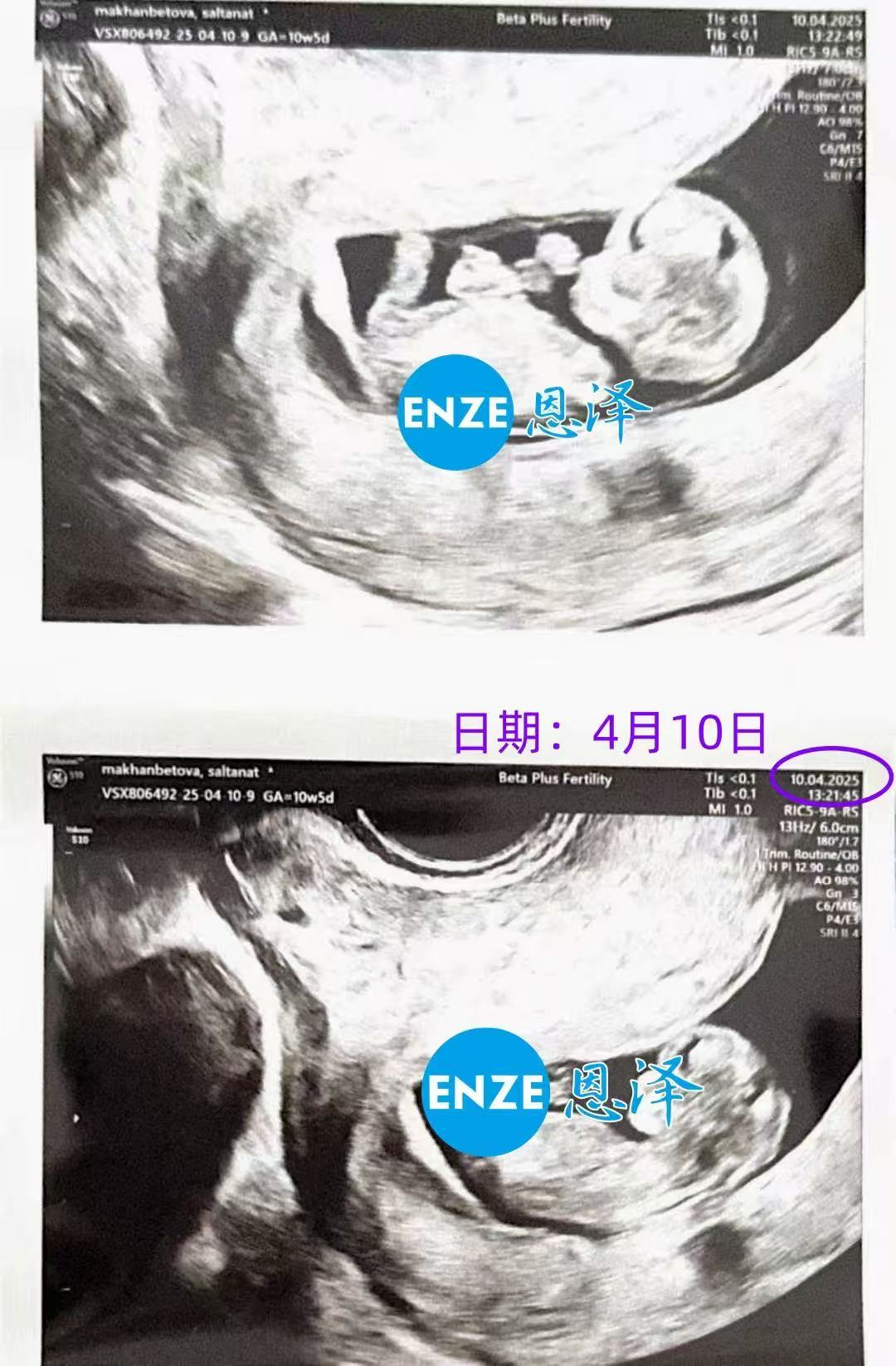 格鲁吉亚试管婴儿助孕爱心使者10周产检顺利通过