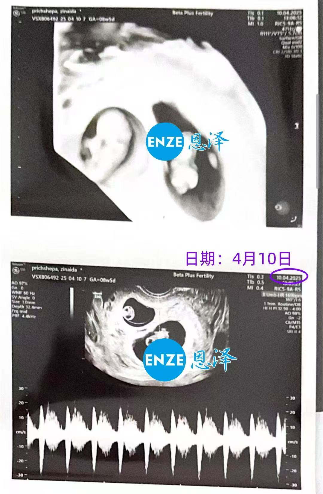 格鲁吉亚试管婴儿助孕爱心使者8周产检成功过关