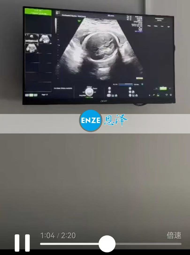 格鲁吉亚试管婴儿助孕爱心使者23周产检完美通过