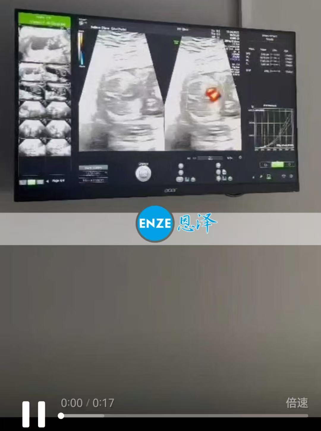 格鲁吉亚试管婴儿助孕爱心使者17周产检顺利完成