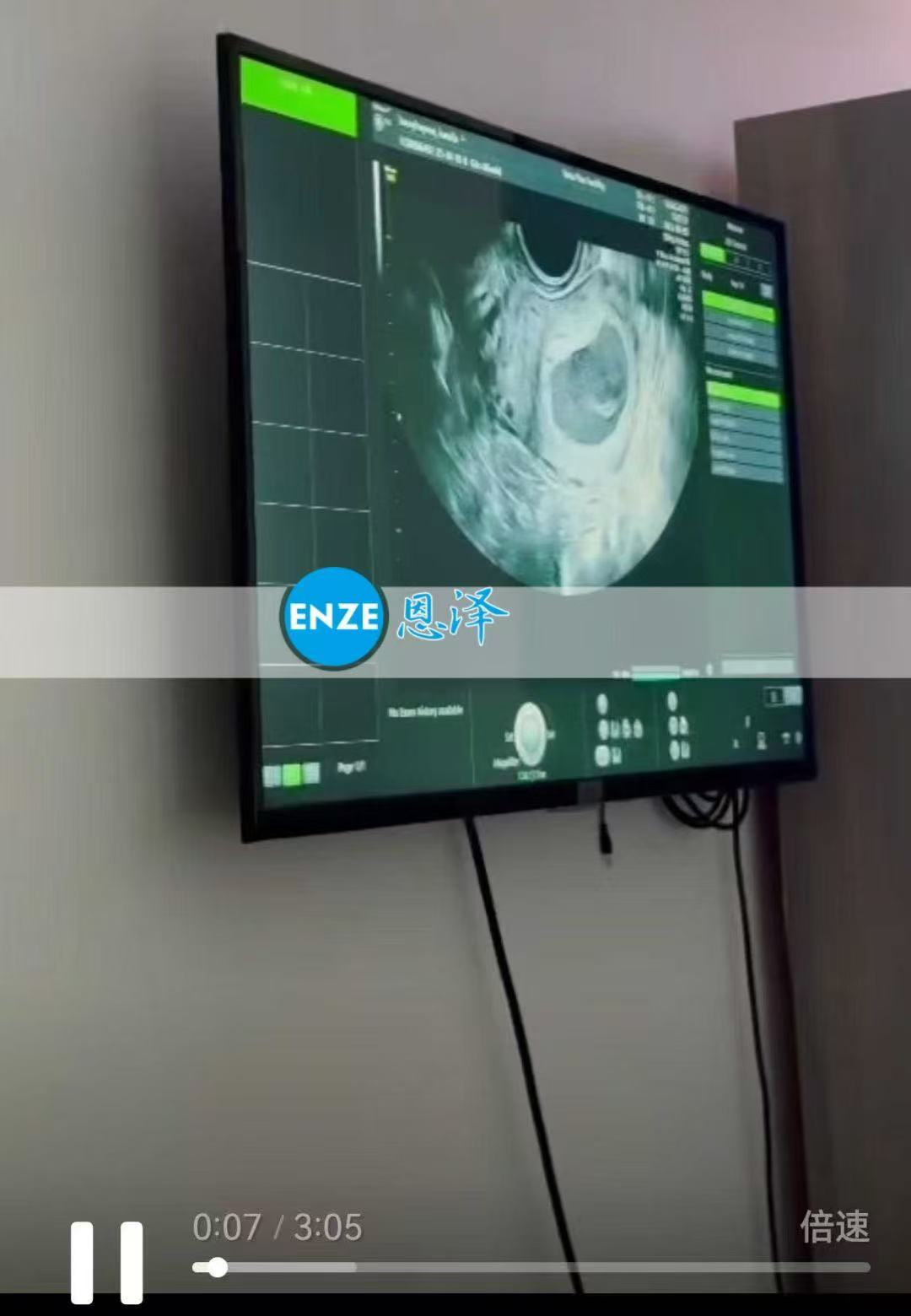 格鲁吉亚试管婴儿助孕爱心使者顺利通过6周首检