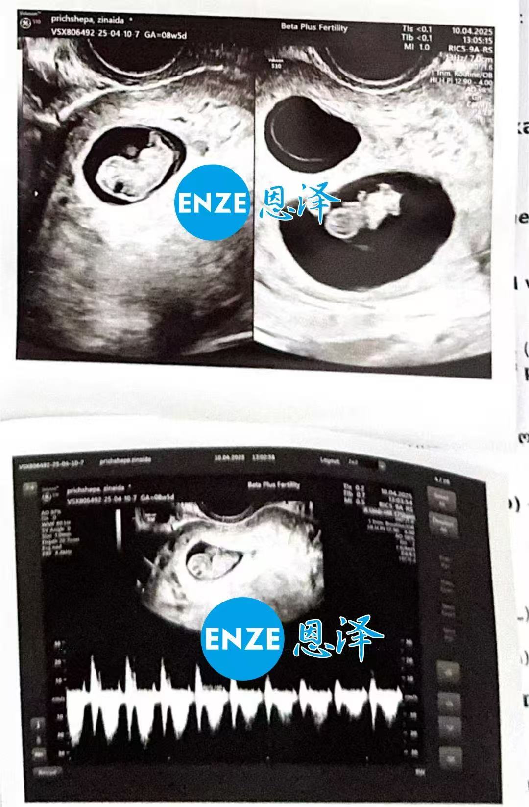 格鲁吉亚试管婴儿助孕爱心使者8周产检成功过关