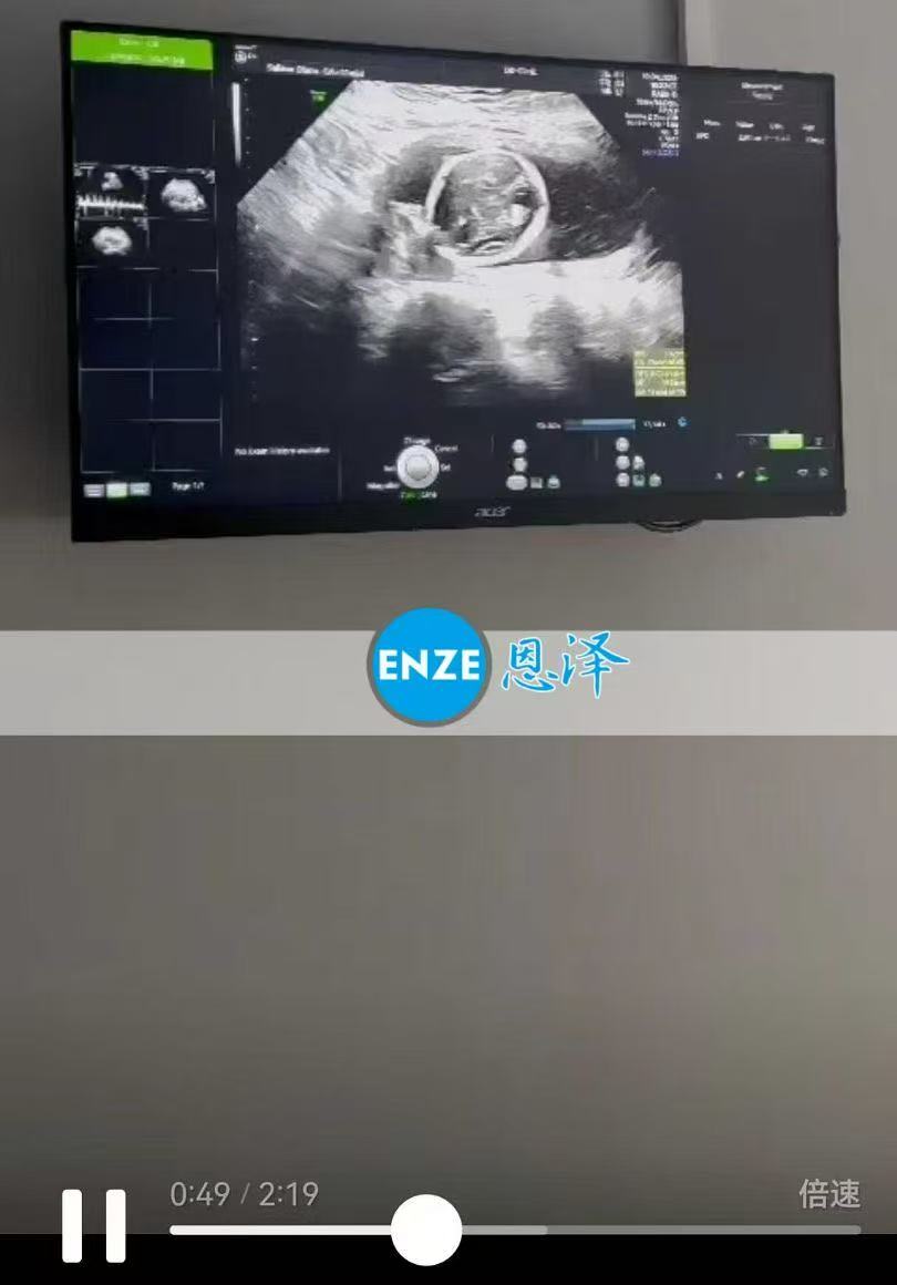 格鲁吉亚试管婴儿助孕爱心使者17周产检顺利完成